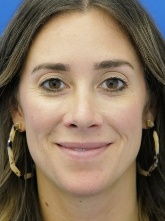 Preservation Rhinoplasty — After