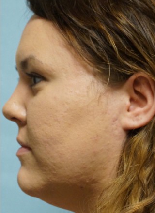 Crooked Nose Endonasal Technique2* — After