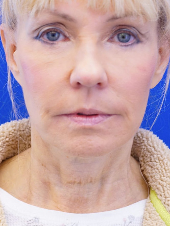 Neck Rejuvenation — Before