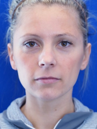 Lip lift* — Before