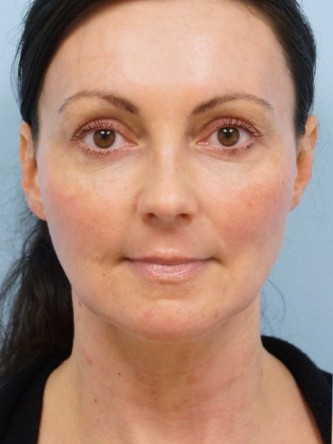 Mini Lift, Laser Resurfacing, Facial Filler* — Before