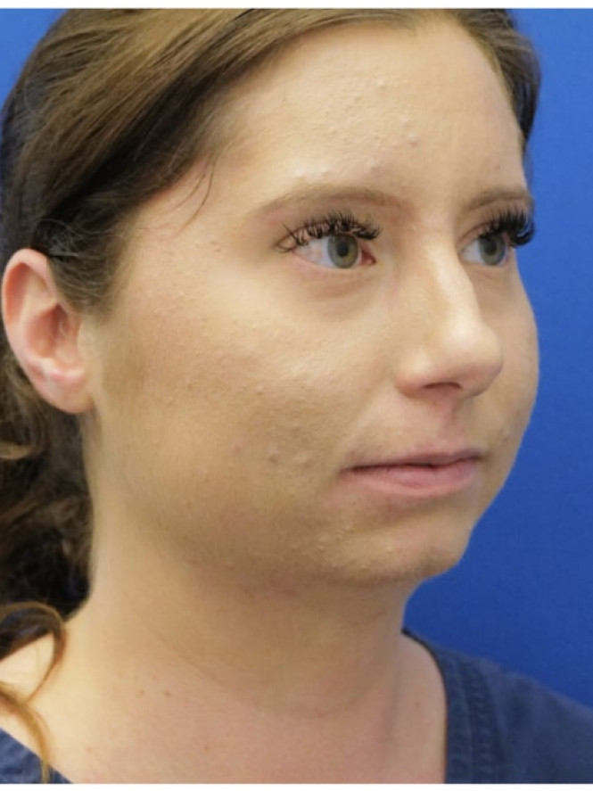 Chin Augmentation and Liposuction — Before