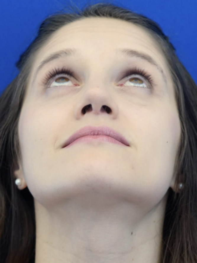 Nasal Profile Bliss — After
