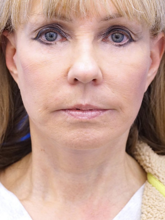 Neck Rejuvenation — After