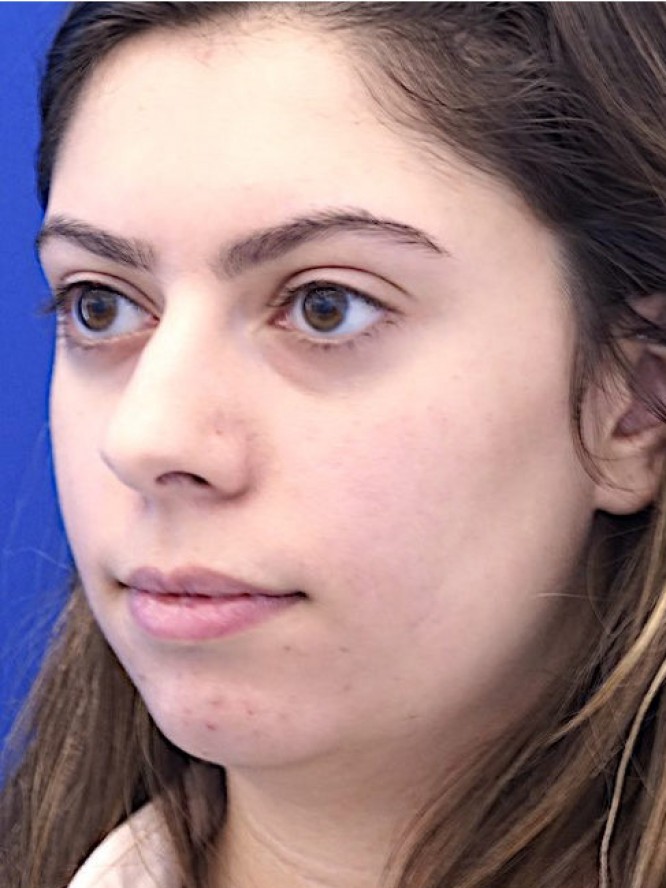 Hump Reduction and Chin Projection — Before