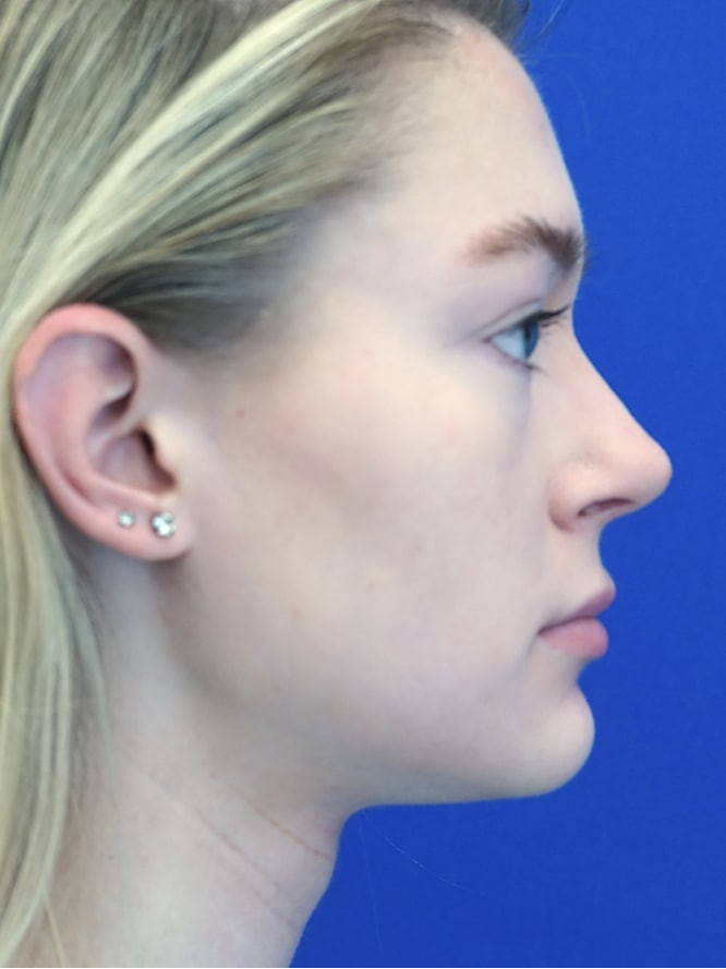 Nasal Profile Plasty — After