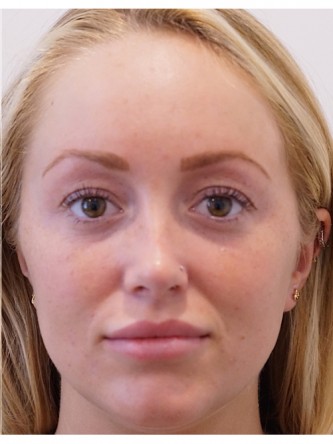 Restylane Silk to Upper & Lower Lips* — After