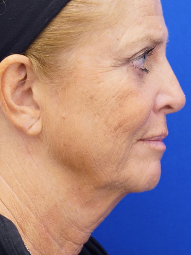 Deep Plane Lower Facelift — Before