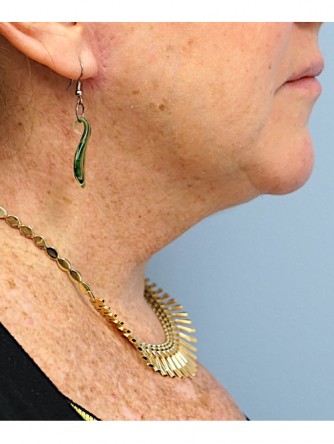 Short Oblique Neck* — After