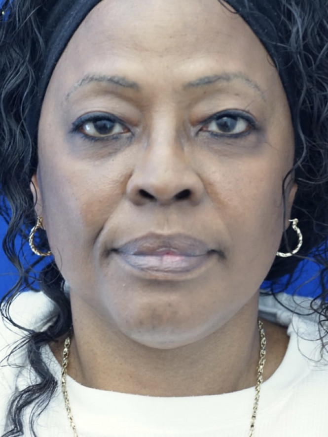 Necklift Platysma Suspension and Liposuction — After