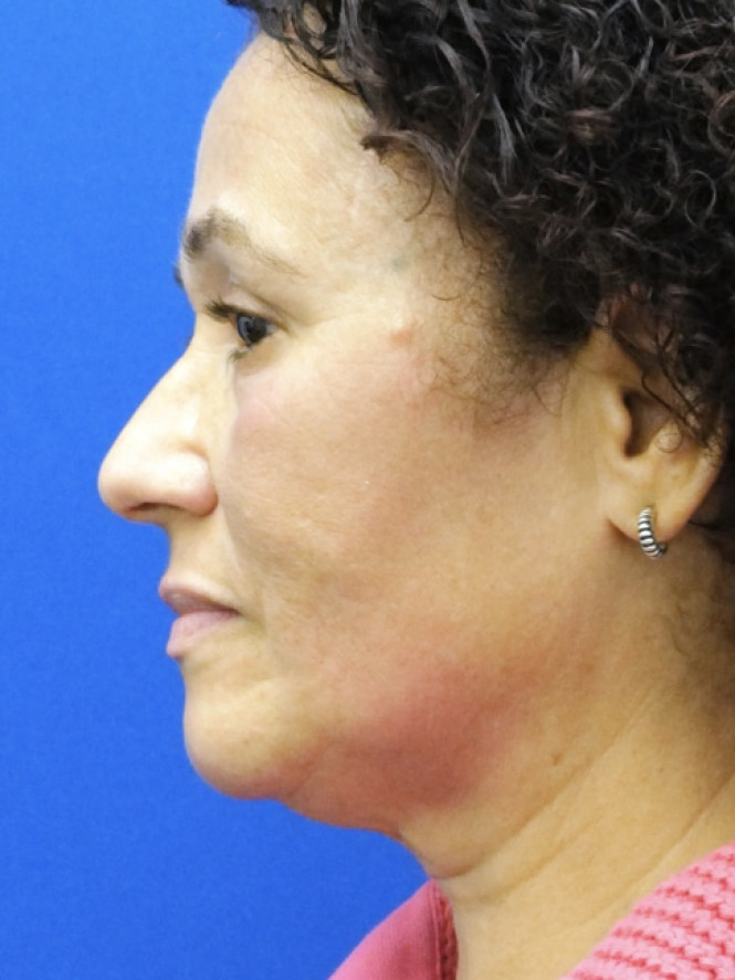 Deep Plane Full Facelift — Before