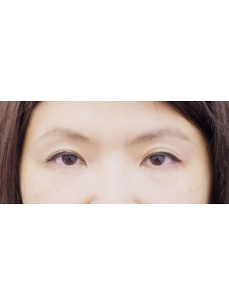 Lower Eyelid Loose Skin and Hollow* — After