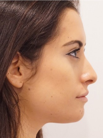 Restylane Silk to Volumize Lower Lip* — After