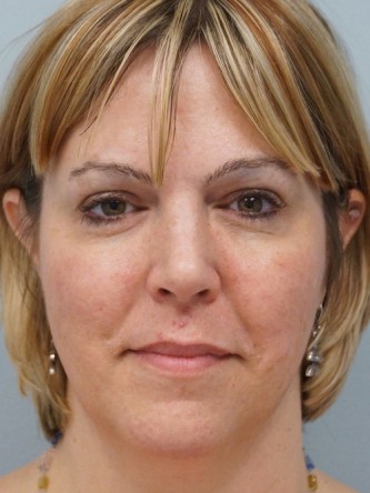 Cheek Augmentation using Voluma* — After
