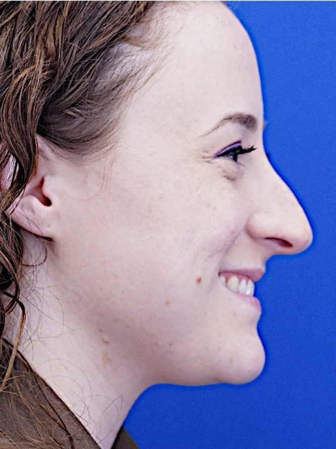 Finesse Nasal Contour — Before