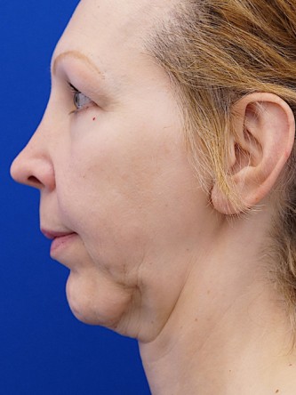 Revision Chin Implant, Mini Lift* — Before