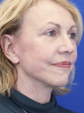 Deep Plane Lift and Superficial Laser — After