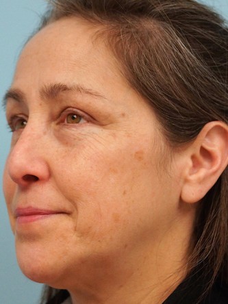 Nasal Septal Perforation2* — Before