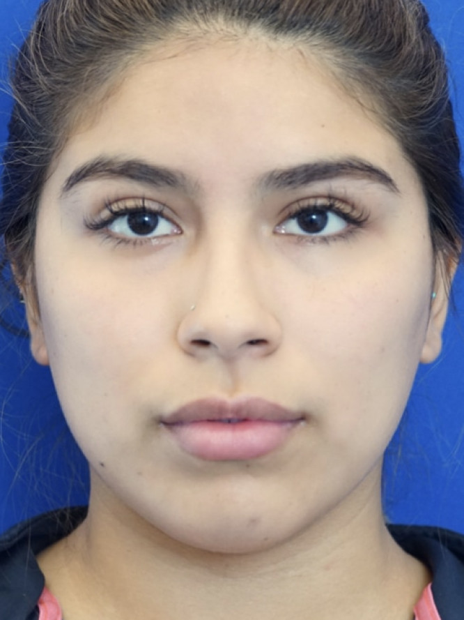 Cheek Contouring — Before