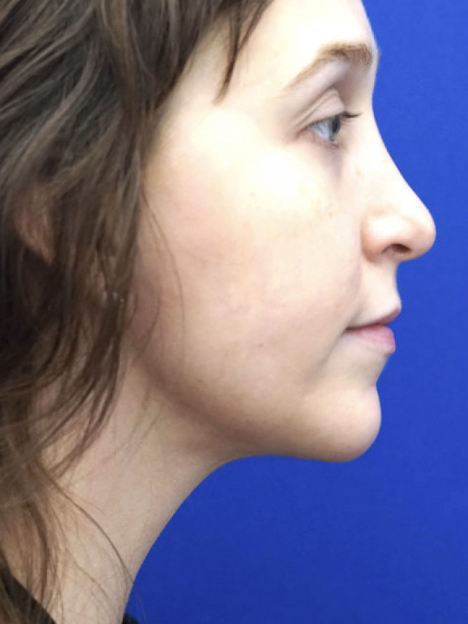 Necklift Subplatysmal Lipectomy — After