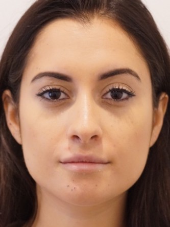 Restylane Silk to Volumize Lower Lip* — After