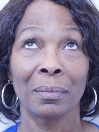 Tear Trough Under Eye Enhancement — After