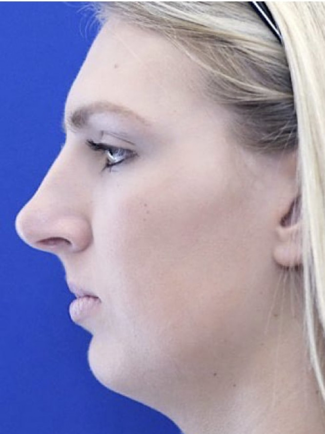 Tension Nose — Before