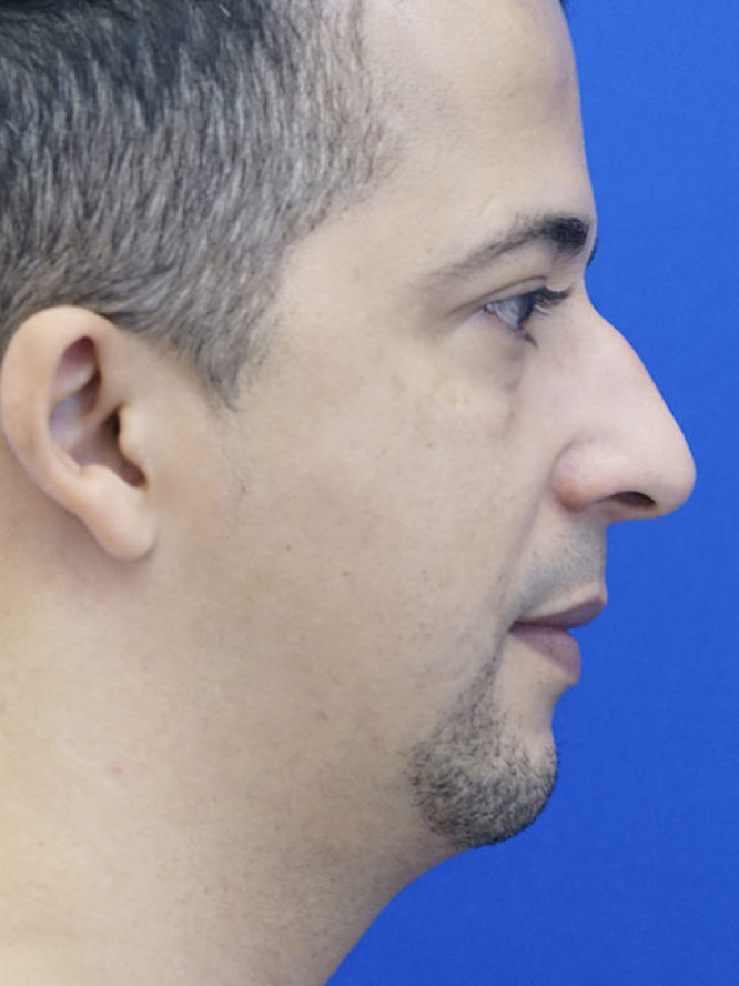 Endonasal Hump Removal — Before