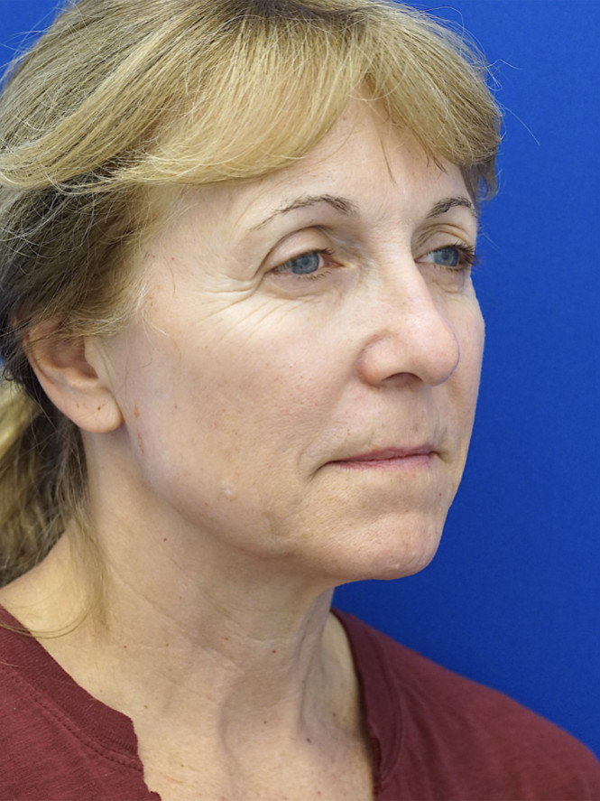 Hairline Browlift — Before
