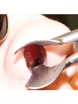 Nasal Septal Perforation3* — Before