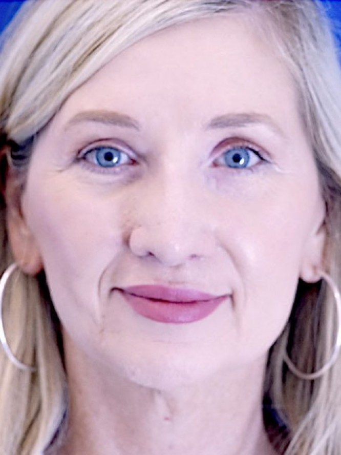 Thick Skin Droopy Nose — After