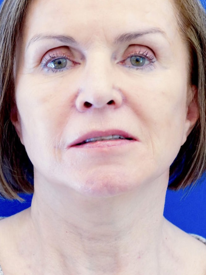 Deep Plane Lift and Fat Grafting — After
