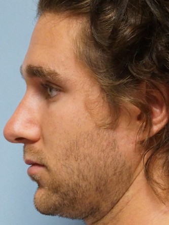 Crooked Nose & Dorsal Hump2* — After