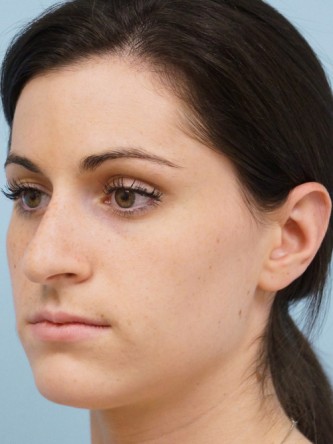 Mild Dorsal Hump & Droopy Tip1* — Before