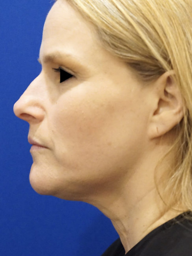 Deep Plane Lower Facelift and Platysmaplasty — Before