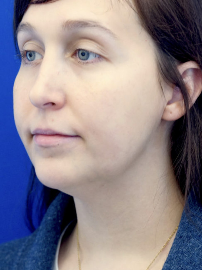Necklift Subplatysmal Lipectomy — Before