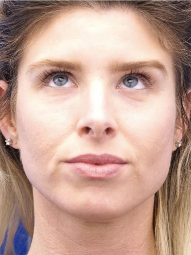 Lower Eyelid Skin Laxity — Before