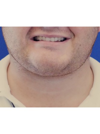 Neck Liposuction* — After