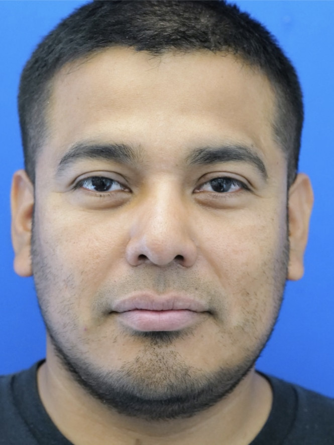 Rhinoplasty Trifecta — After