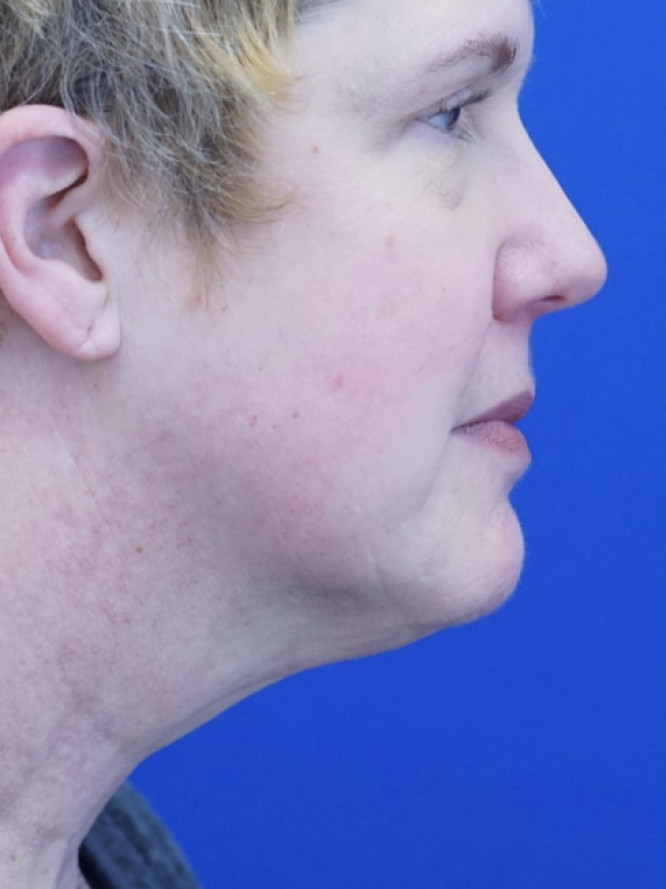 Facelift Platysmaplasty with Subplatysmal Lipectomy — Before