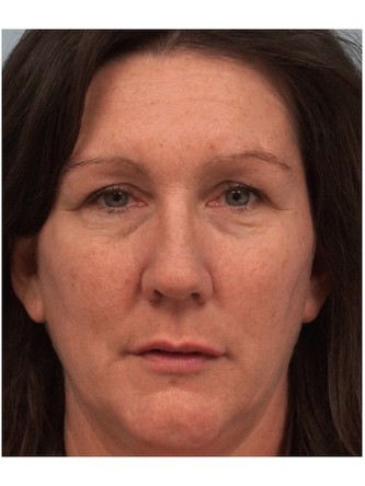Juvederm to Upper Lip* — After