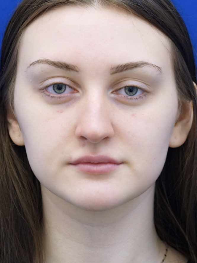 Natural Profile — Before