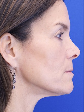 Nasal Tip Deformity — Before