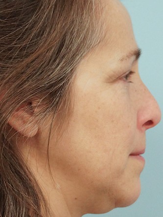 Nasal Septal Perforation2* — Before