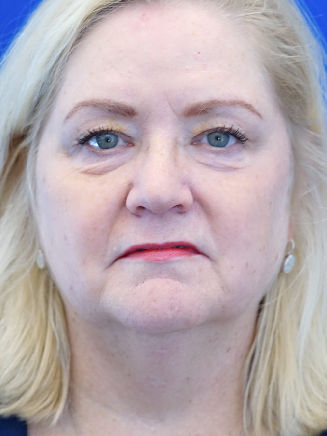 Lower Eyelid Rejuvenation — Before