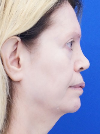 Sunken Nasal Base and Upper Lip* — Before