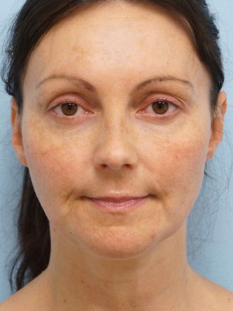 Mini Lift, Laser Resurfacing, Facial Filler* — Before