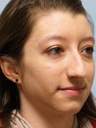 Prominent Nose Closed Rhinoplasty* — Before