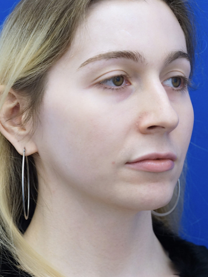 Soften Nasal Contour — Before