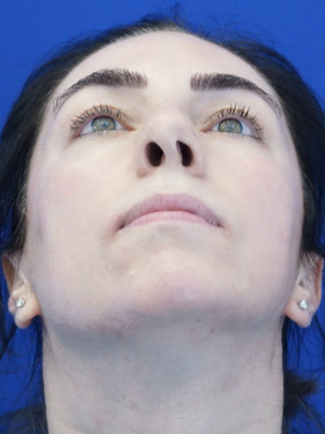 Tip Asymmetry — Before